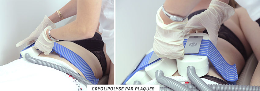 Cryolipolyse plaques