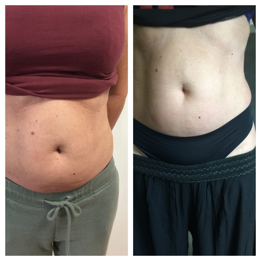 Cryolipolyse ventre Centre Le Tibere
