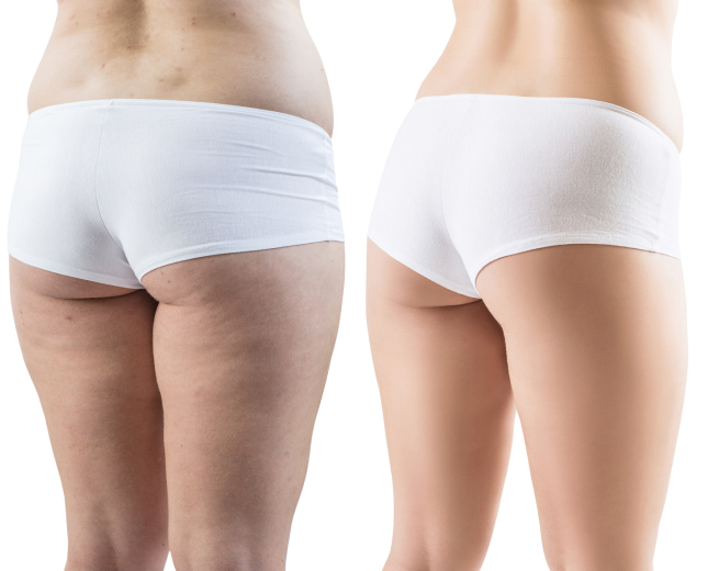 cryolipolyse cuisses femme arriere