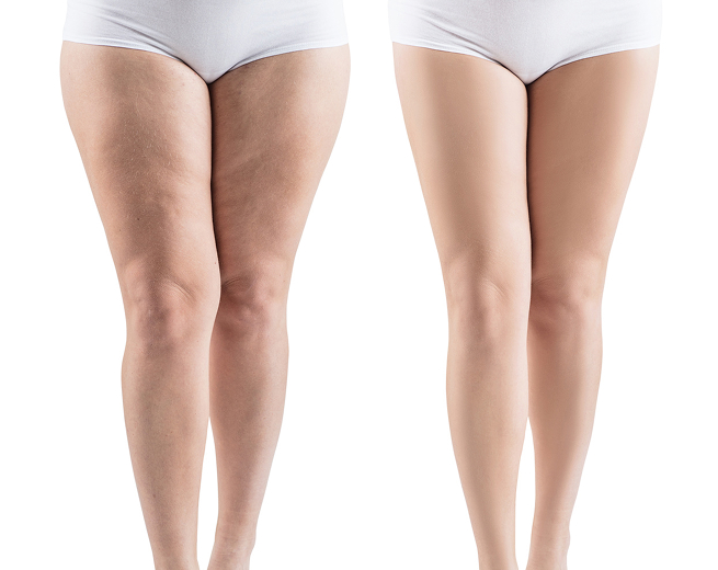 cryolipolyse cuisses femme avant